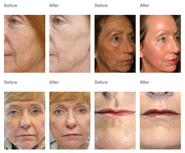 Fractional_CO2_Ablative_Resurfacing_Before-After_Gallacher